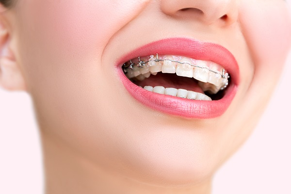 Things You May Not Have Known About Clear Braces